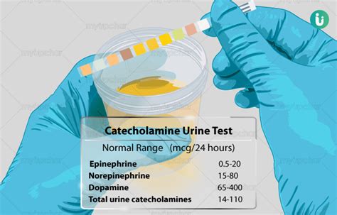 Catecholamine Urine Test: Procedure, Purpose, Results, Cost, Price