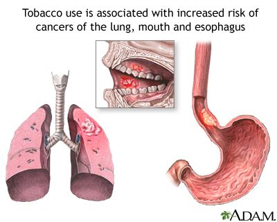 Tobacco and cancer: MedlinePlus Medical Encyclopedia Image