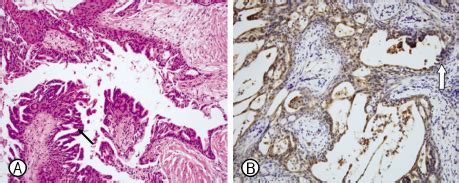 Histology of the resected neck nodule (A: H&E, ×200; B: Galectin-3,... | Download Scientific Diagram