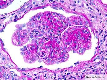 MPGN = nephrotic Microscopic Cells, Microscopic Images, Kidney Biopsy, Medical Science, Rocks ...