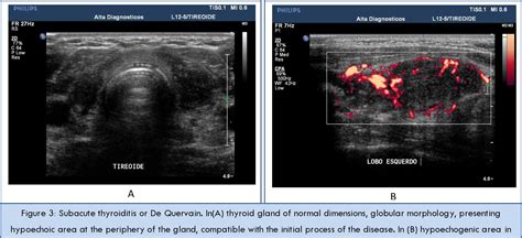 Figure 3 from Ultrasound Evaluation of Thyroiditis : A Review ...