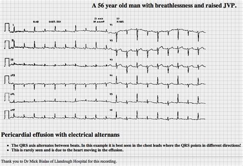 ECG Class - Keeping ECGs Simple: Autumn1 - Electrical Alternans