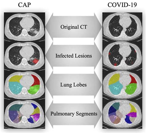 Illustration Of The Lungs Lobes And Segments This Ima - vrogue.co