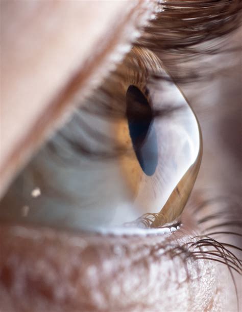 Keratoconus Treatment Melbourne | Keratoconus Specialists