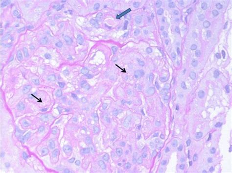 Histology (F.D.-C.). Diffuse thickening and endothelial cell ...