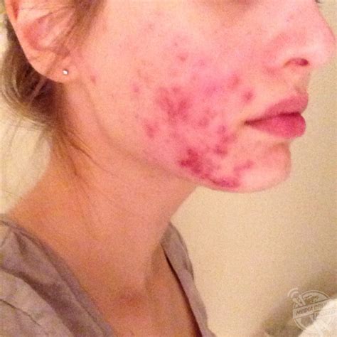 This Girl Developed Severe Cystic Acne That Left Her Face Permanently Scarred But Is Embracing ...