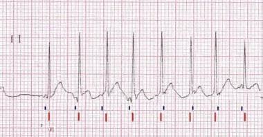 94 Which of the Following Are Treatments for Junctional Tachycardia - Jabari-has-Lyons