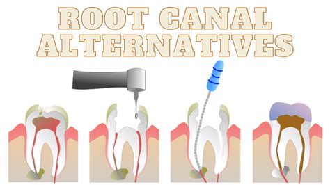 Alternatives to Root Canal | Dentcaretips - Dental Care Tips