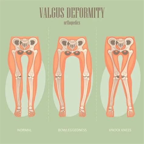 Knee Valgus: How To Fix Knock Knees - Elite Feet