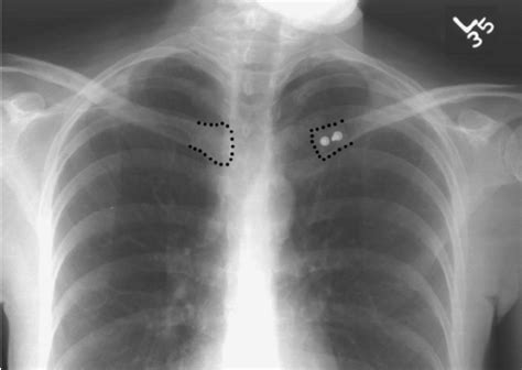 Preoperative (A) anteroposterior and (B) serendipity... - Figure 5 of 6