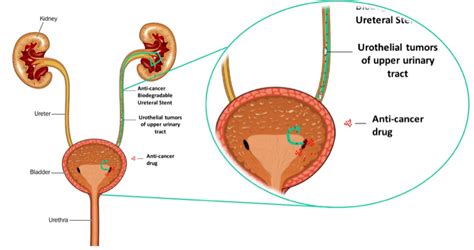 Frontiers | Targeting urothelial tumors of upper urinary tract with drug-eluting stents ...