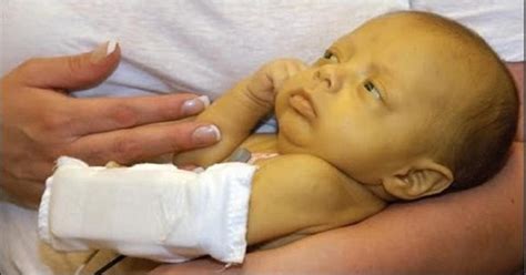 What Is Jaundice In Premature Babies - Get More Anythink's