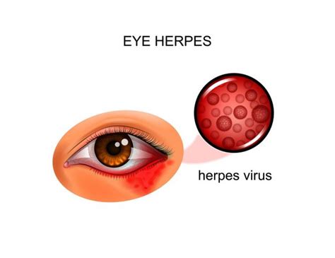 Viral Eye Infection: Types, Symptoms, Treatment | STD.GOV Blog