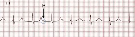 First Degree Heart Block • LITFL • ECG Library Diagnosis