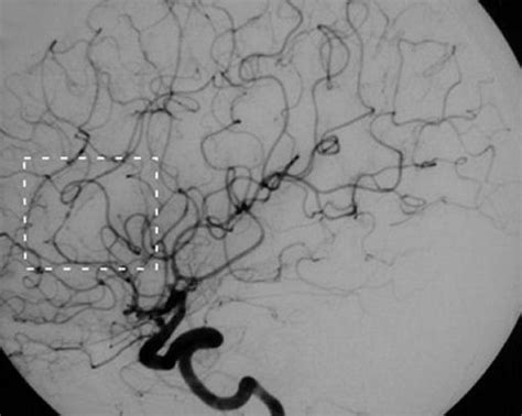 Cerebral_Vasculitis