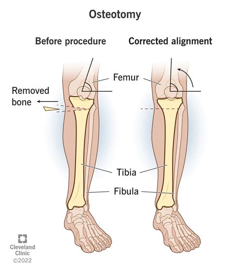 Osteotomy (Bone Cutting): What It Is, Procedure & Recovery