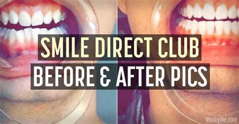 45 Smile Direct Club Before & After Photos, Transformation Pics!