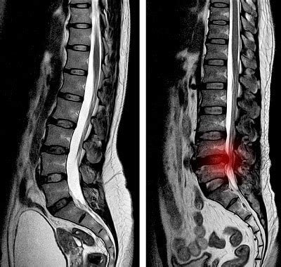 Collapsed Disc - What is a Collapsed Disc? | Spine & Orthopedic Center