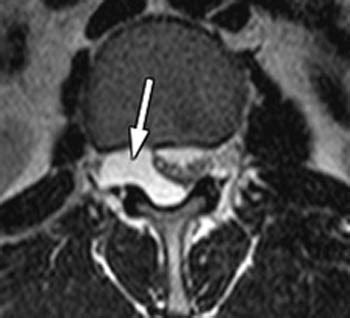 Large Synovial Cyst With Spinal Steno Large Synovial Cyst With Spinal ...