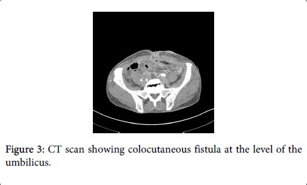 gastrointestinal-digestive-system-colocutaneous-fistula