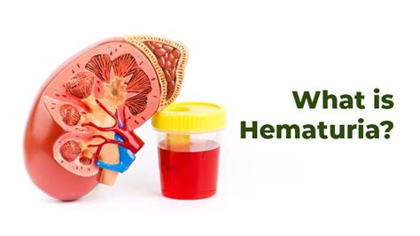 What is Hematuria?. Hematuria is a medical condition… | by Trustwell Hospitals Pvt. Ltd. | Medium