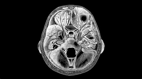 Lobotomy Procedure