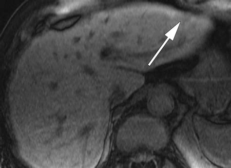 Complications of Intravesical BCG Immunotherapy for Bladder Cancer ...