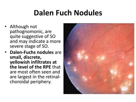 PPT - SYMPATHETIC OPHTHALMIA PowerPoint Presentation - ID:4504446