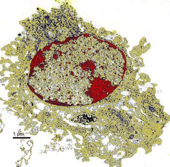 Nanoparticulate Carbon Black Found in the Lungs of Smokers