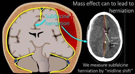 Subfalcine Herniation