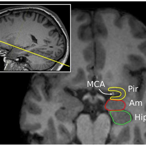 (PDF) The Piriform Cortex and Human Focal Epilepsy