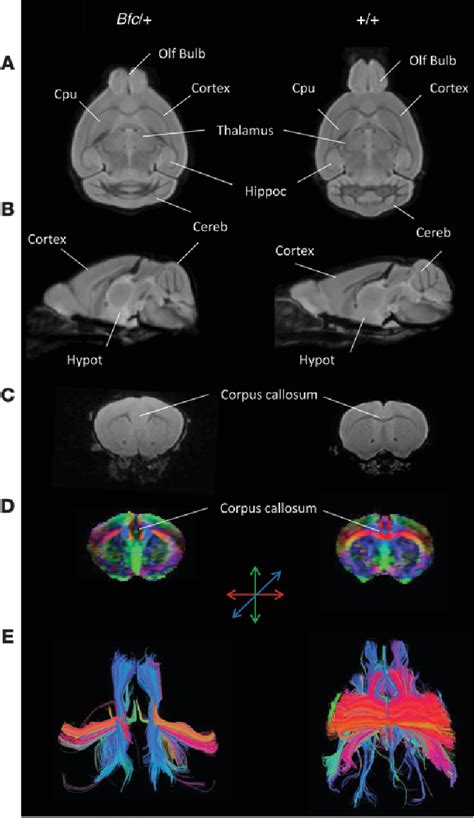 Figure 3 from Dominant β-catenin mutations cause intellectual ...