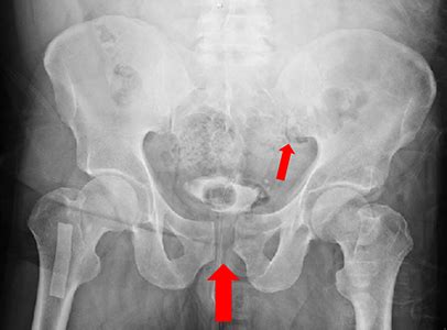 Pelvis Fracture | Orthopaedic Trauma Association (OTA)