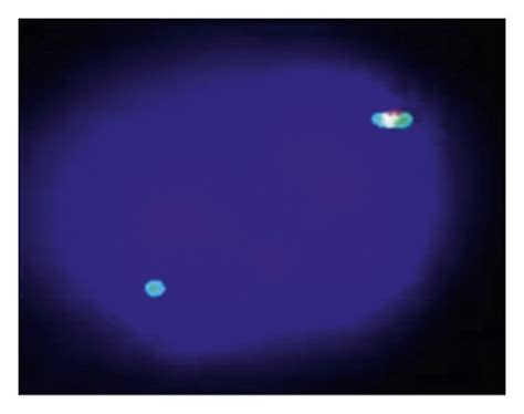 Bone marrow aspirate morphology and FISH result: (a) Bone marrow... | Download Scientific Diagram