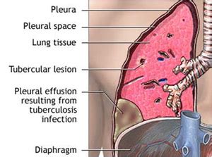 Empyema - laparoscopyindia.com | Laparoscopic and Thoracoscopic Surgery