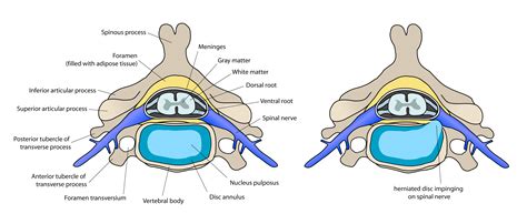 Spinal disc herniation - wikidoc