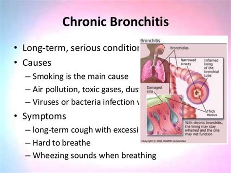 chronic bronchitis causes - DriverLayer Search Engine