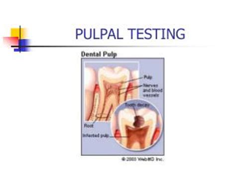 PPT - PULPAL TESTING PowerPoint Presentation - ID:786779