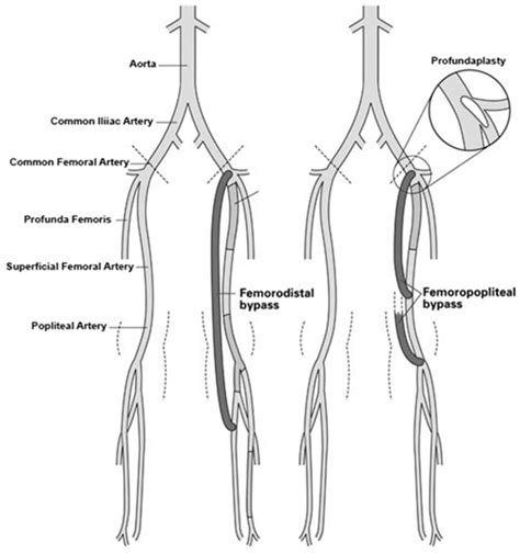 Springfield Heart Surgeons LLC - Femoral Bypass Surgery