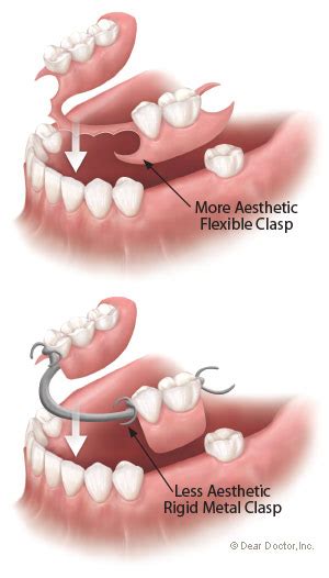 Flexible Partial Dentures - Biermann Orthodontics