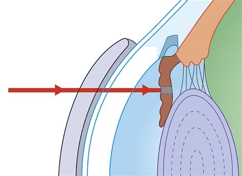 Laser Peripheral Iridotomy (LPI) — Hobsons Bay Eye Surgeons | Melbourne ...