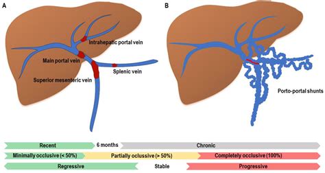 JCM | Free Full-Text | Portal Vein Thrombosis in the Setting of ...