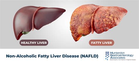 ไขมันพอกตับ (fatty liver disease) ภัยเงียบที่มาพร้อมกับ ความอ้วน