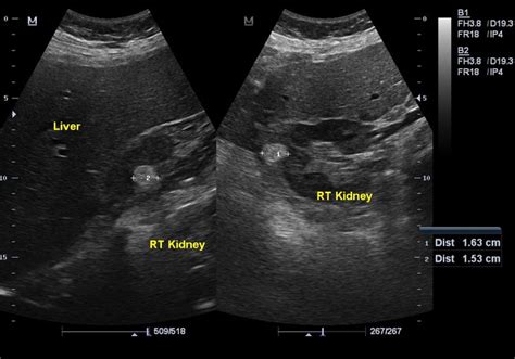 Renal Angiomyolipoma Ultrasound