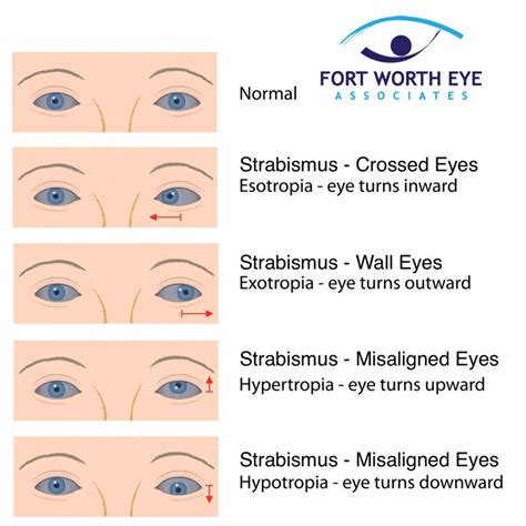 Strabismus Surgery for Misaligned Eyes, Crossed Eyes, or Wall Eyes