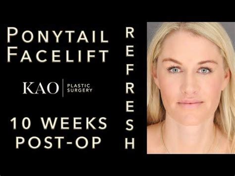 Ponytail Facelift Before And After Plastic Surgery Video - Jowl Lift ...