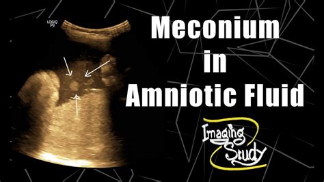 Meconium in Amniotic Fluid || Ultrasound || Case 62 - YouTube