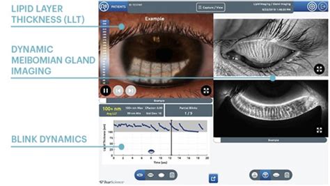 What a Dry Eye Exam Looks Like | Dr. Shaver | The Eye Center