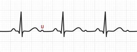 The U Wave | ECG Basics - MedSchool