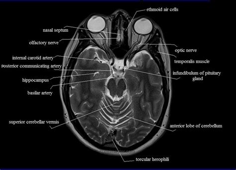 Mri brain, Radiology, Brain anatomy